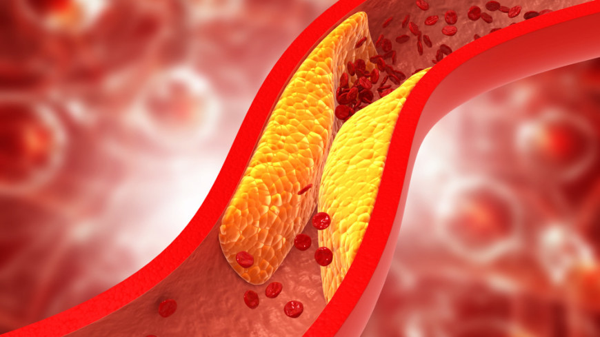 Кардиолог предупредил об опасности повышенного холестерина