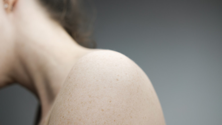 Как спасти бледную кожу от ожогов летом: рекомендации дерматолога