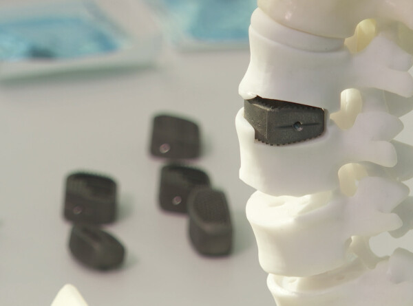 Первые 3D-позвонки из титана для парализованных пациентов зарегистрировали в России