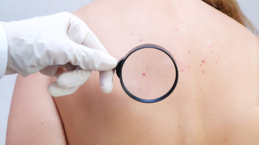 Онколог назвал пять неочевидных симптомов рака кожи