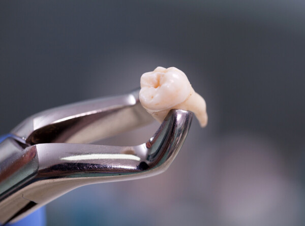 Британка вырвала себе зуб плоскогубцами после сотни попыток записаться к врачу